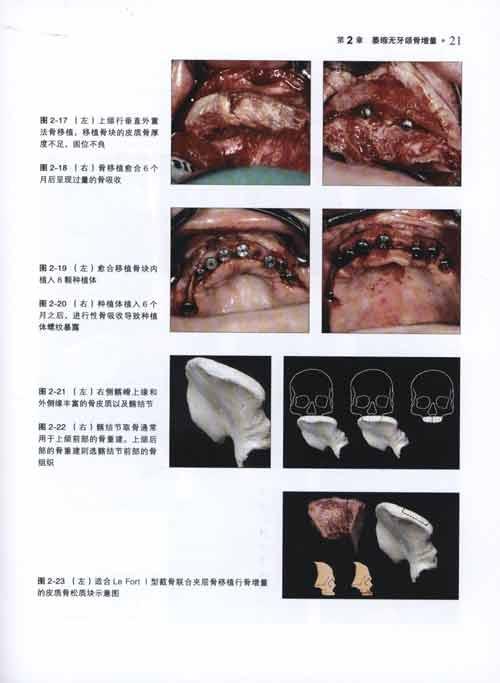 口腔颌面种植的骨增量技术