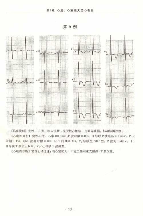 心电图简谱_正常心电图图片(2)